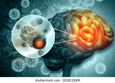 Brain Cancer, Showing Presence Of Tumor Inside Brain. 3d Illustration