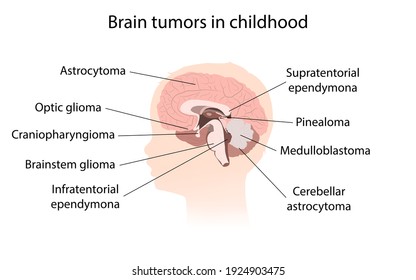 Brain Cancer, Tumor With Explanations. Silhouette Of Kid Child Head, Inner View.