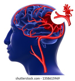 Brain Hemorrhage. 3d Rendering