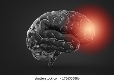 Brain Inflammation Or Other Process Associated With Tissues Damage Or Thinking Conceptual 3d Illustration Helpful For In Visualizing Brain Diseases.