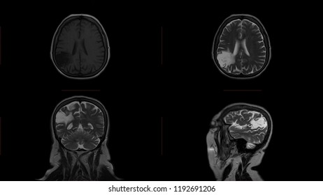 Brain MRI In Different Modes And Planes In Patient With Stroke