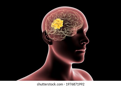 Brain Mucormycosis, A Brain Lesion Caused By Fungi Mucor, Also Known As Black Fungus, 3D Illustration