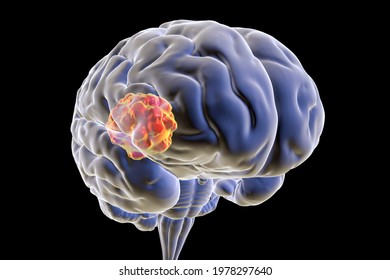 Brain Mucormycosis, A Brain Lesion Caused By Fungi Mucor, Also Known As Black Fungus, 3D Illustration