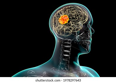 Brain Mucormycosis, A Brain Lesion Caused By Fungi Mucor, Also Known As Black Fungus, 3D Illustration