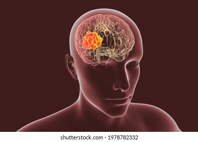 Brain Mucormycosis, A Brain Lesion Caused By Fungi Mucor, Also Known As Black Fungus, 3D Illustration