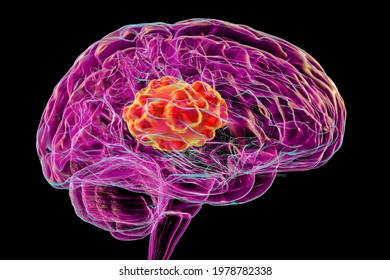 Brain Mucormycosis, A Brain Lesion Caused By Fungi Mucor, Also Known As Black Fungus, 3D Illustration