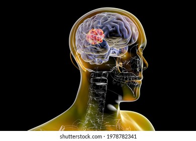 Brain Mucormycosis, A Brain Lesion Caused By Fungi Mucor, Also Known As Black Fungus, 3D Illustration
