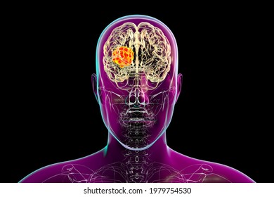 Brain Mucormycosis, A Brain Lesion Caused By Fungi Mucor, Also Known As Black Fungus, 3D Illustration