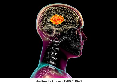 Brain Mucormycosis, A Brain Lesion Caused By Fungi Mucor, Also Known As Black Fungus, 3D Illustration