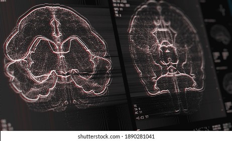 Brain scan screen. Device scans, displays vital signs. Neurology data. Diagnosis of diseases. Futuristic MRI conept. 3D Render Illustration, glitch and noise effect, color aberrations, Depth of Field