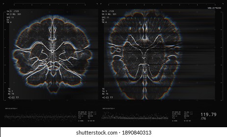 Brain scan screen. Device scans, displays vital signs. Neurology data. Diagnosis of diseases. Futuristic MRI conept. 3D Render Illustration, glitch and noise effect, color aberrations, Depth of Field
