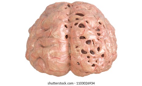 Brain In Severe Brain Disease, Dementia, Alzheimer, Chorea Huntington - 3D Rendering