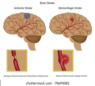 Brain Stroke