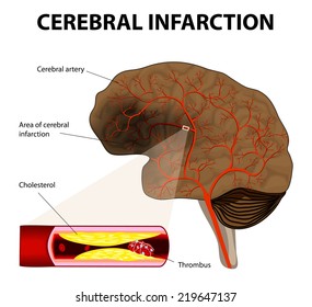 Brain Stroke. Cerebral Infarction. The Obstruction Is Caused By A Blood Clot That Forms In A Cerebral Artery, At An Atheromatous Plaque.