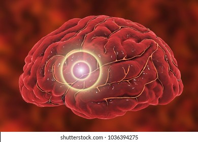 Brain Stroke Concept. Migraine And Headache Conceptual Image, 3D Illustration