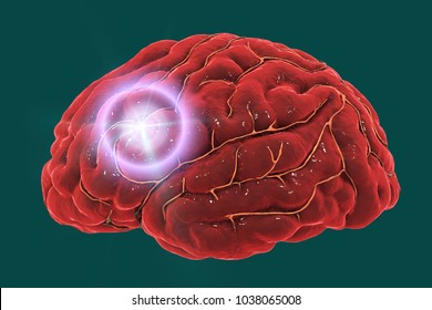 Brain Stroke Concept. Migraine And Headache Conceptual Image, 3D Illustration