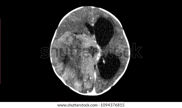 Brain tumor
and hydrocephalus in medical
imaging