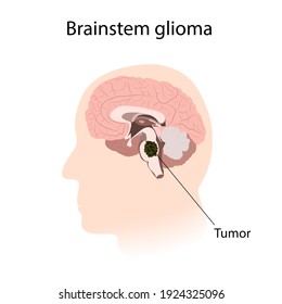 Brainstem Glioma. Brain Cancer, Tumor With Explanations.