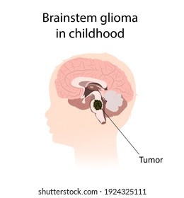 Brainstem Glioma In Childhood. Brain Cancer, Tumor With Explanations.