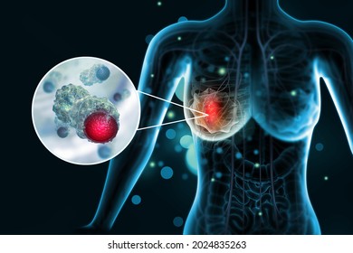 Breast Cancer. Female Breast Anatomy. 3d Illustration