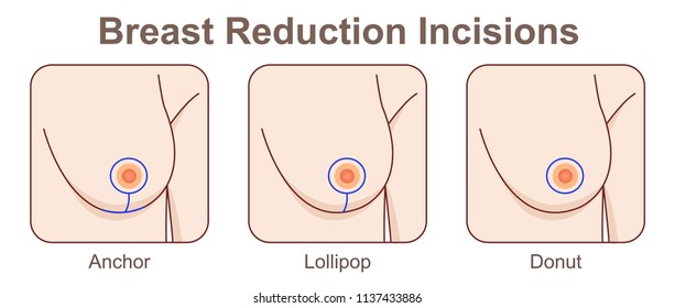 Breast Reduction Incisions