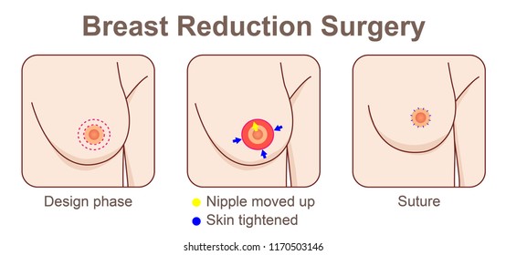 Breast Reduction Surgery