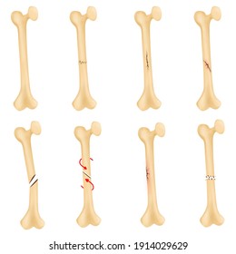 Broken Bone Fracture Stock Illustration 1914029629 | Shutterstock