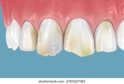 Broken and damaged front teeth. 3D illustration