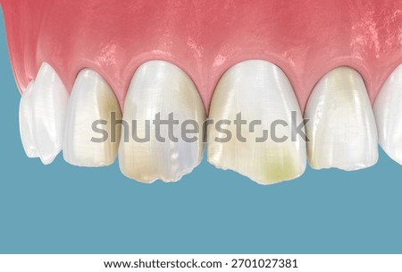 Broken and damaged front teeth. 3D illustration