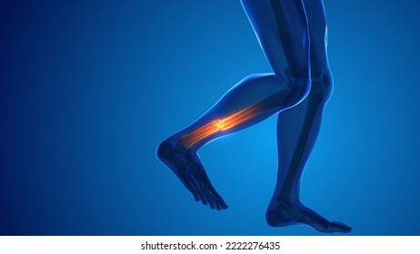 Broken Leg Bone Pain Medical Concept 3D Illustration