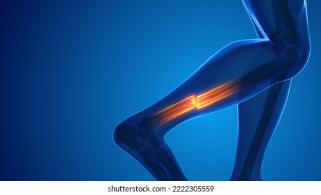 Broken Leg Bone Pain Medical Concept 3D Illustration