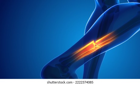 Broken Leg Bone Pain Medical Concept 3D Illustration