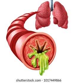 Bronchitis Anatomy Concept As An Inflammation Of Bronchial Tube Lining With Thick Mucus Secreted As A Chest Cold As A 3D Illustration Elements.