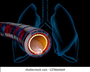 Bronchitis Anatomy, Mucus Secreted As A Chest Cold As A 3D Illustration