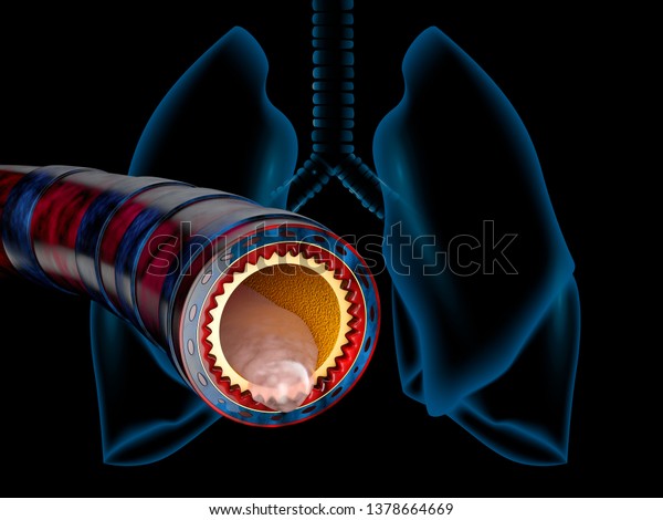 Bronchitis anatomy, mucus secreted as a\
chest cold as a 3D\
illustration
