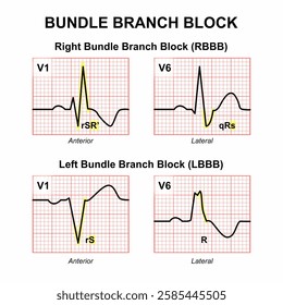 Bundle Branch Block | LBBB, RBBB Illustration