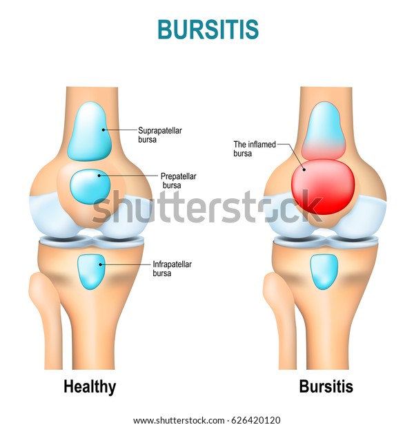 Bursitis. Healthy human\'s knee and knee with\
inflammation of bursae (synovial\
fluid).