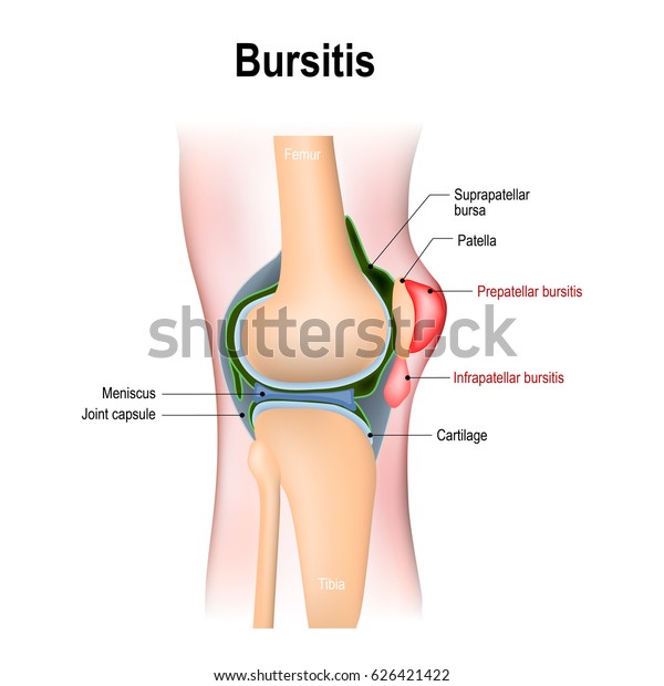 Bursitis.\
inflammation of bursae (synovial fluid). Prepatellar bursitis\
(housemaid\'s knee) and Infrapatellar\
bursitis