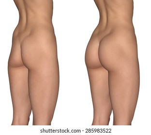 Buttock Augmentation