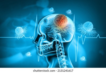 Cancer Tumor In Human Brain, Braintumor. 3d Illustration