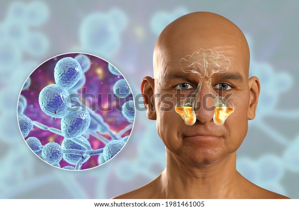 Candida Fungi Cause Sinusitis 3d Illustration Stock Illustration ...