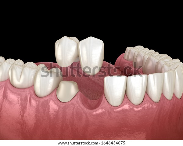 Cantilever bridge
made from ceramic, frontal tooth recovery. Medically accurate 3D
animation of dental
concept