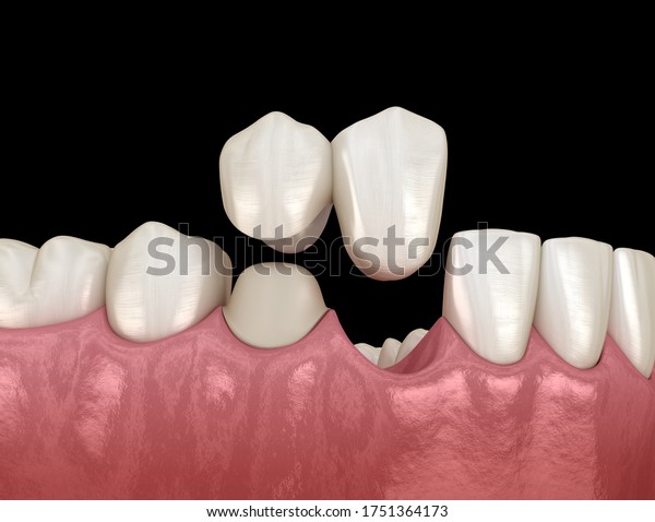 Cantilever bridge\
made from ceramic, frontal tooth recovery. Medically accurate 3D\
animation of dental\
concept
