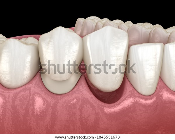Cantilever bridge\
made from ceramic, frontal tooth recovery. Medically accurate 3D\
animation of dental\
concept
