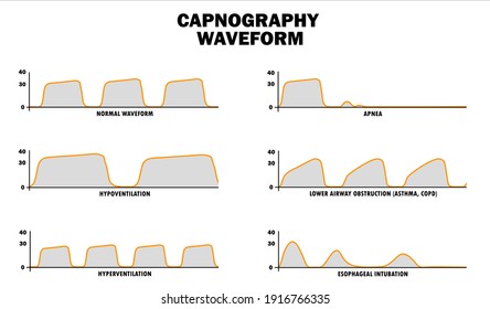 normal range of capnography