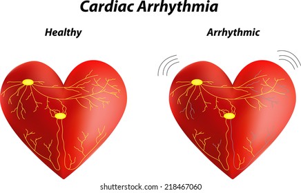 Cardiac Arrhythmia 