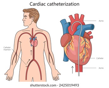 Cardiac catheterization structure diagram hand drawn schematic raster illustration. Medical science educational illustration