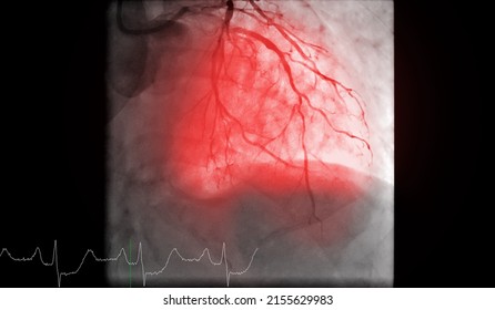 Cardiac Catheterization Is A Test Used To Find Out  Cardiac Arrest .