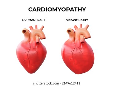 Cardiomyopathy Is Inflammation In The Heart Muscle, Resulting In Its Enlargement And Weakening That Impairs The Blood's Pumping Ability. 3D Illustration