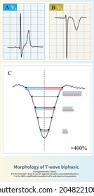 Careful Analysis Of The Morphology Of Coronal T Wave Can Only Say That Its Symmetry Increases And Is Asymmetric In Essence. From The Peak Of T Wave To The Baseline Of T Wave, The Asymmetry Increases.